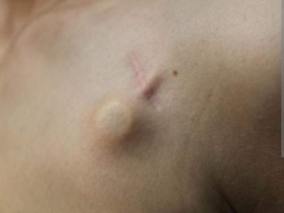 Tout savoir sur la chambre implantable